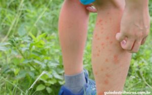 o que passar em picada de borrachudo